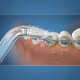 Embout Hydropulseur - WATERPIK - Orthodontique - Élimine la plaque - Spécial appareils dentaires